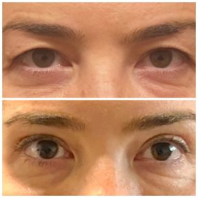 before-after photo blepharoplasty-eyelid