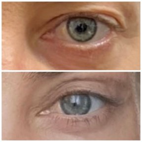 before-after photo blepharoplasty-eyelid