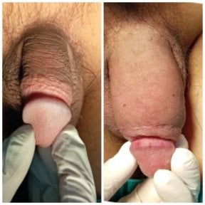 before-after photo surgical-penile-lengthening