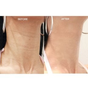 before-after photo fillers-injection