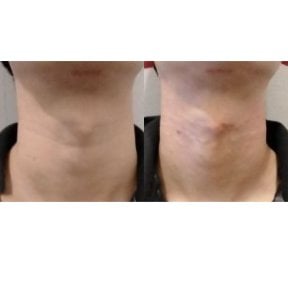 before-after photo fillers-injection