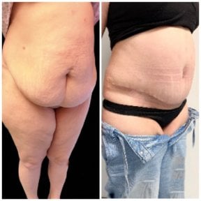 before-after photo abdominoplastika-i-liposakcia