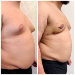 before-after photo gynecomastia-surgery