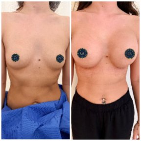 before-after photo breast-augmentation
