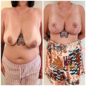 before-after photo breast-lift-with-implants-round