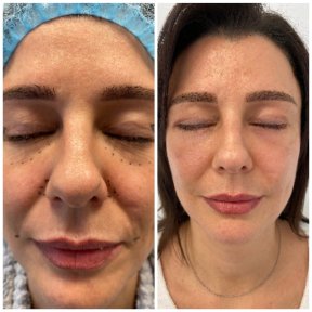 before-after photo blepharoplasty-eyelid