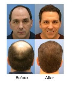 before-after photo penis-enlargement