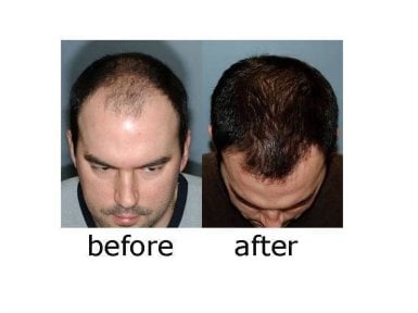 before-after photo penis-enlargement