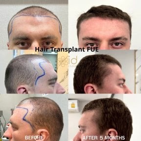 before-after photo penis-enlargement
