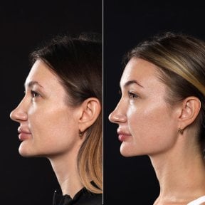 before-after photo glubokaya-podtyazhka-lica-deep-plane-facelift
