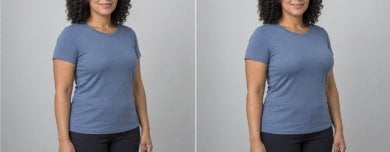 before-after photo breast-augmentation