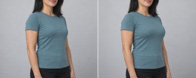 before-after photo breast-augmentation
