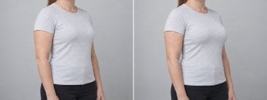 before-after photo breast-augmentation
