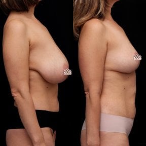 before-after photo breast-reduction