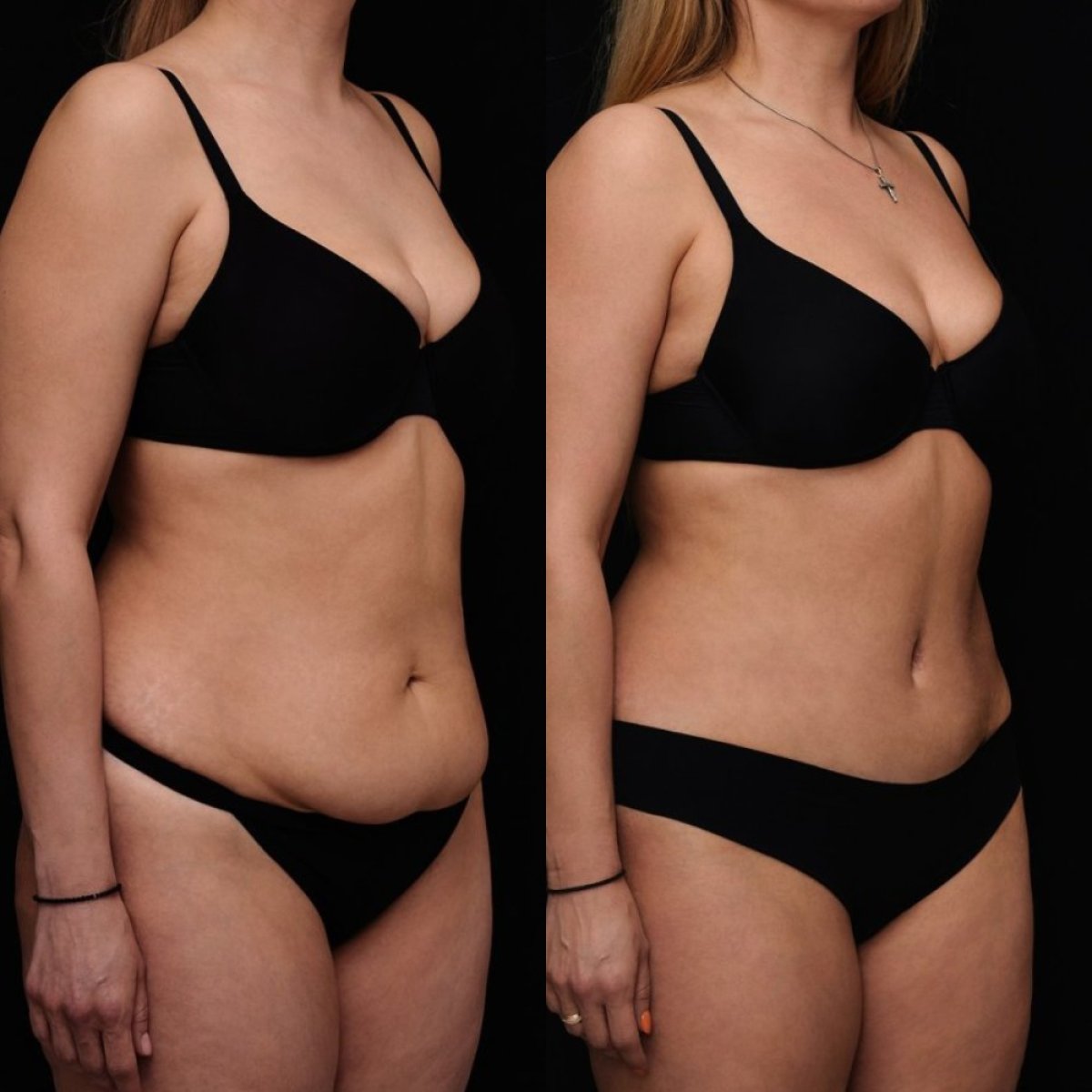 Resultados de abdominoplastia antes y después en Vidnova Clinic – abdomen mejorado