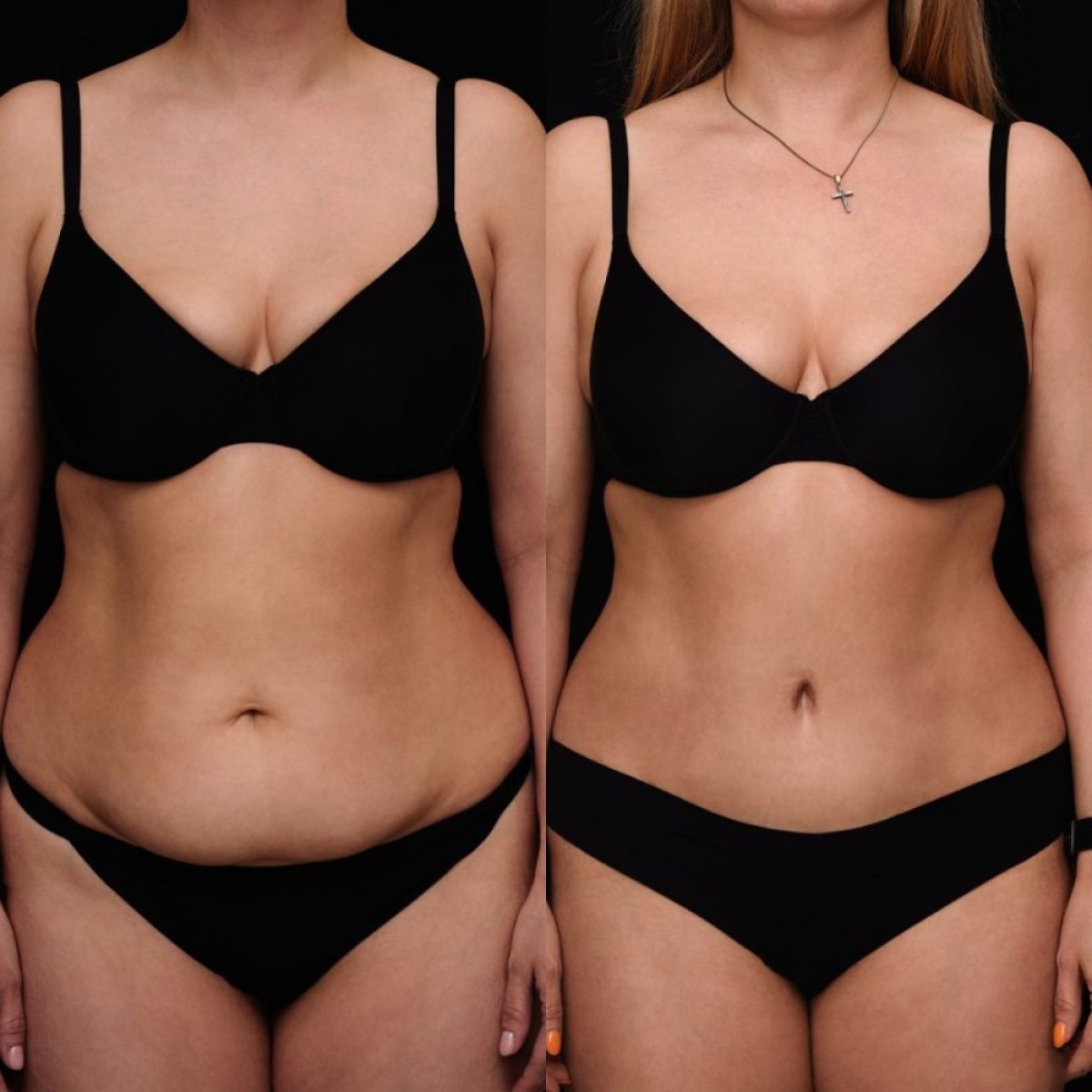 Resultados de abdominoplastia antes y después en Vidnova Clinic – mejora del contorno abdominal
