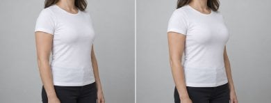 before-after photo breast-augmentation-with-silicone-implants