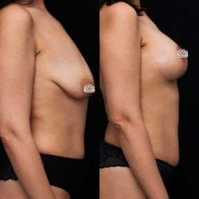 before-after photo mastopexy-breast-lift-contour-plastics