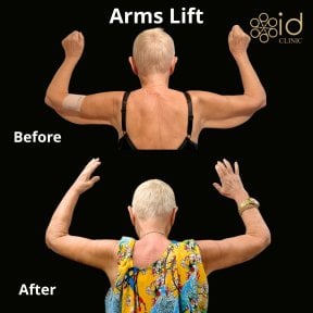 before-after photo body-lift