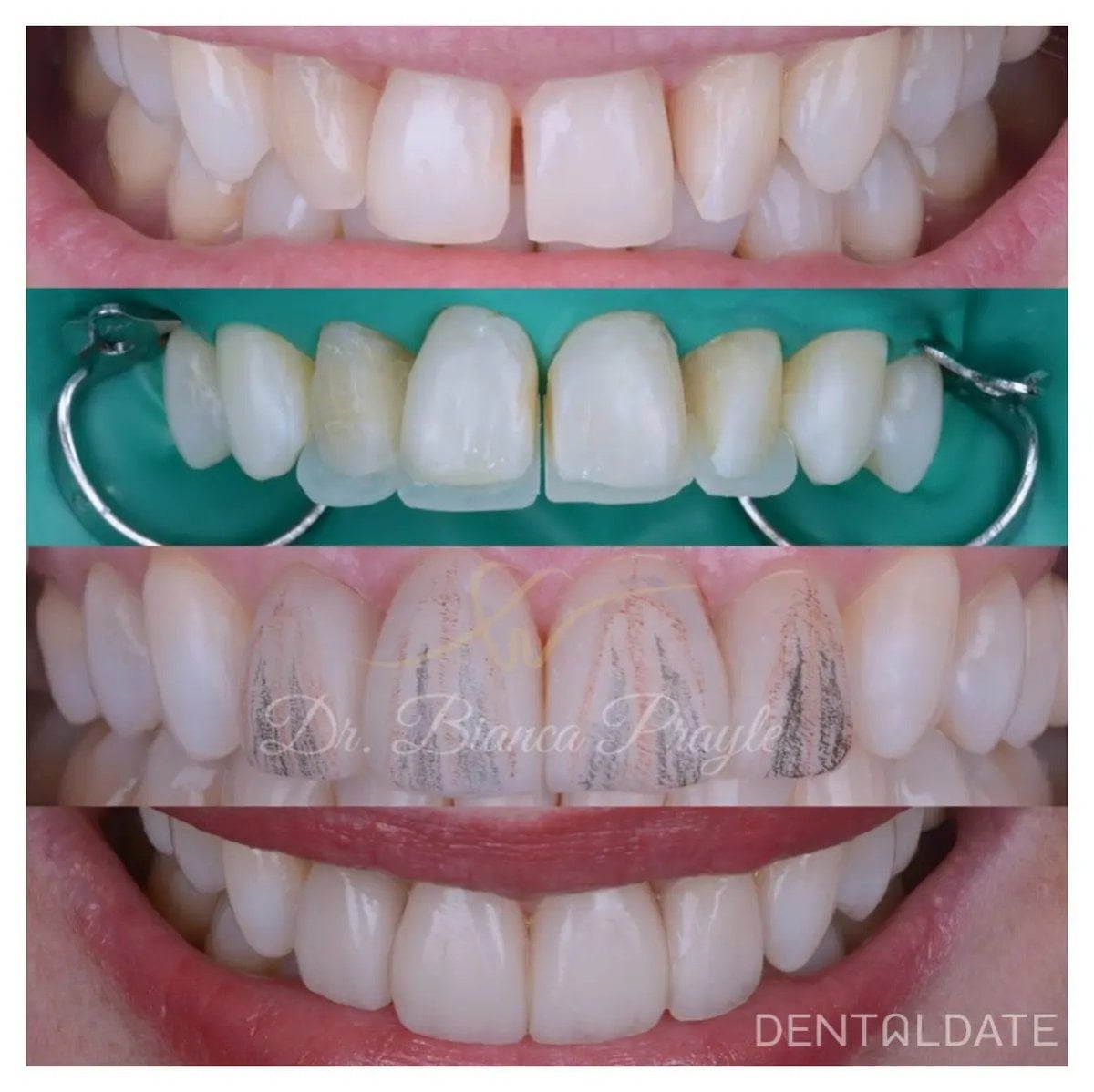 نتائج الفينير قبل وبعد في عيادة DentalDate – تحول الابتسامة وتبييض الأسنان
