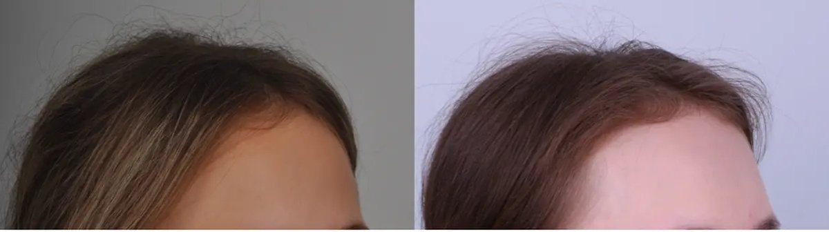 نتائج زراعة الشعر قبل وبعد – خط شعر محسن وكثافة شعر أكبر