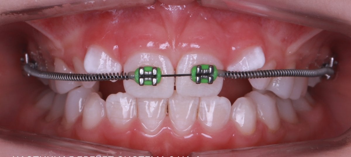 Resultado del tratamiento de ortodoncia con brackets y alambres para alinear dientes