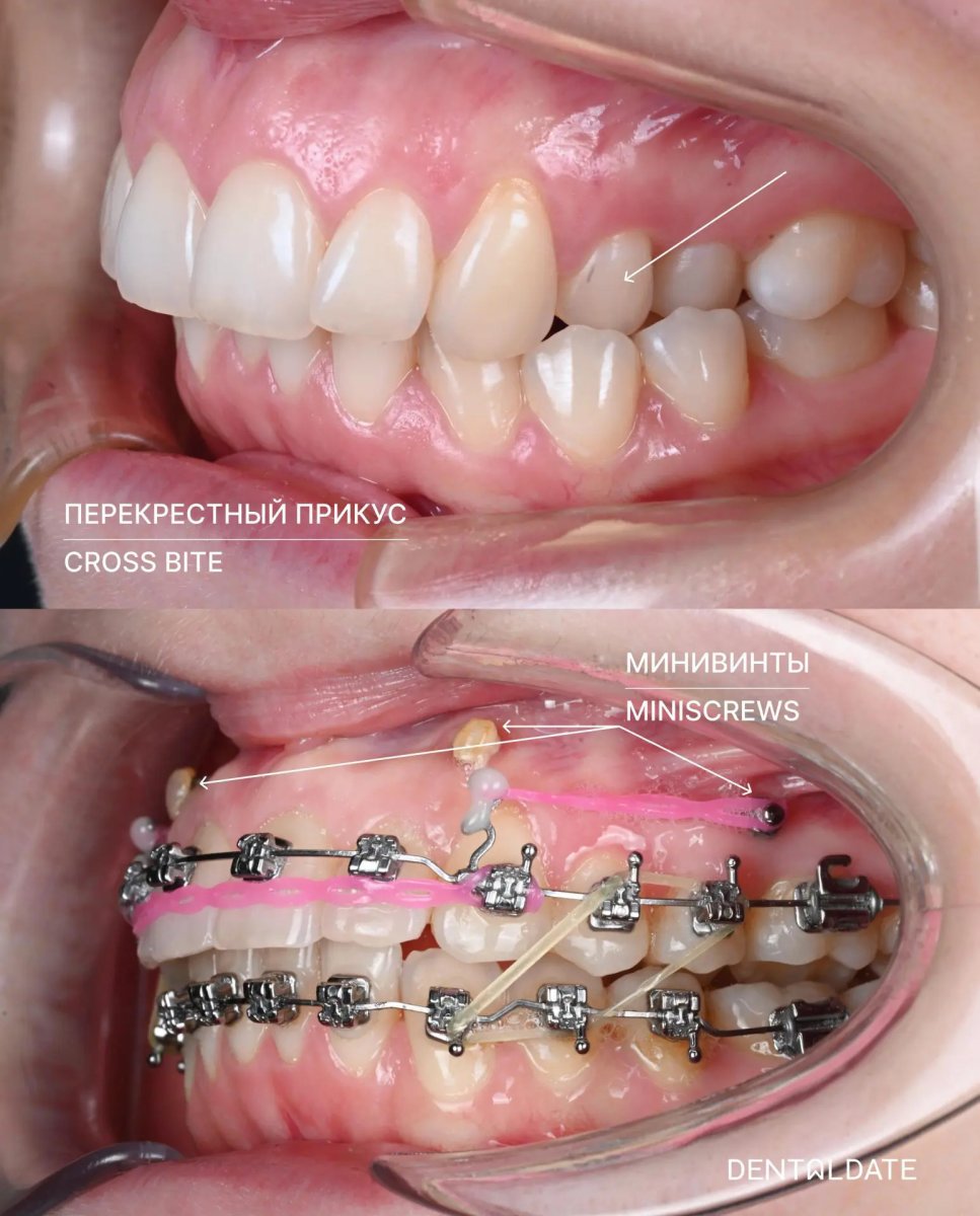 Resultado antes y después de brackets para corrección de mordida cruzada con mini tornillos en Dental Date