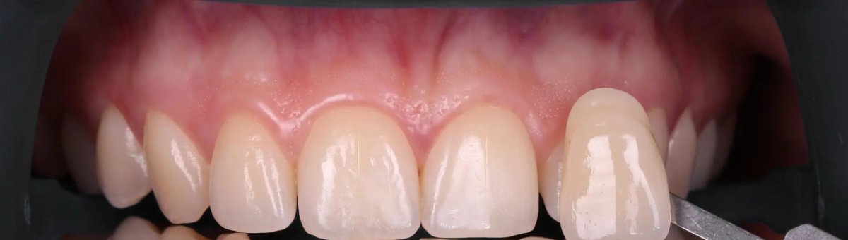 Comparación de tonos tras blanqueamiento dental, resultado de sonrisa más brillante