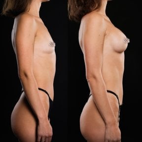 before-after photo mammoplasty