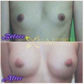 before-after photo breast-augmentation-with-fat-transfer