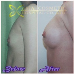 before-after photo breast-augmentation-with-fat-transfer