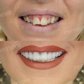 before-after photo dental-crown-installation