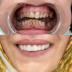before-after photo dental-crown-installation