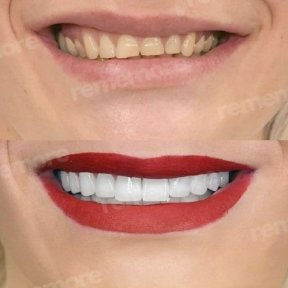 before-after photo dental-crown-installation