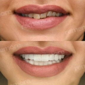 before-after photo dental-crown-installation