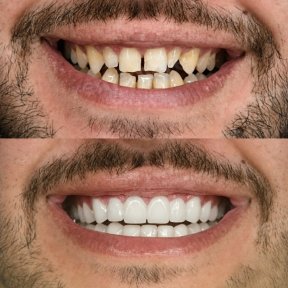 before-after photo dental-crown-installation