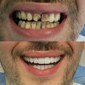 before-after photo dental-crown-installation