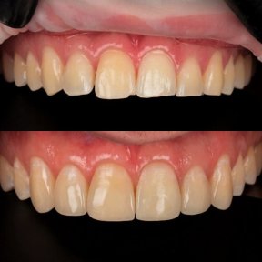 before-after photo aesthetic-composite-filling