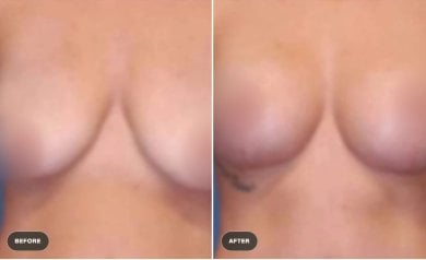 before-after photo breast-augmentation-with-silicone-implants