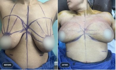before-after photo breast-augmentation-with-silicone-implants