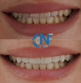 before-after photo viniry-emax