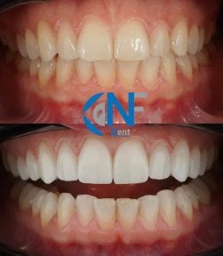 before-after photo viniry-emax