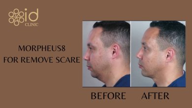 before-after photo skin-rejuvenation
