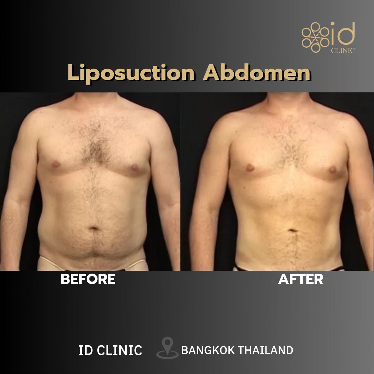 Resultados antes y después de liposucción Vaser abdomen en ID Clinic Bangkok, contorno visible