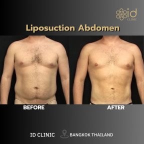 before-after photo vaser-liposuction