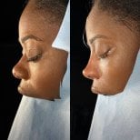 نتائج تجميل الأنف قبل وبعد في مستشفى لوكمان حكيم إسطنبول، إعادة تشكيل الأنف