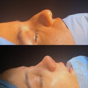 Результаты ринопластики до и после в Lokman Hekim Istanbul Hospital, улучшенный профиль носа