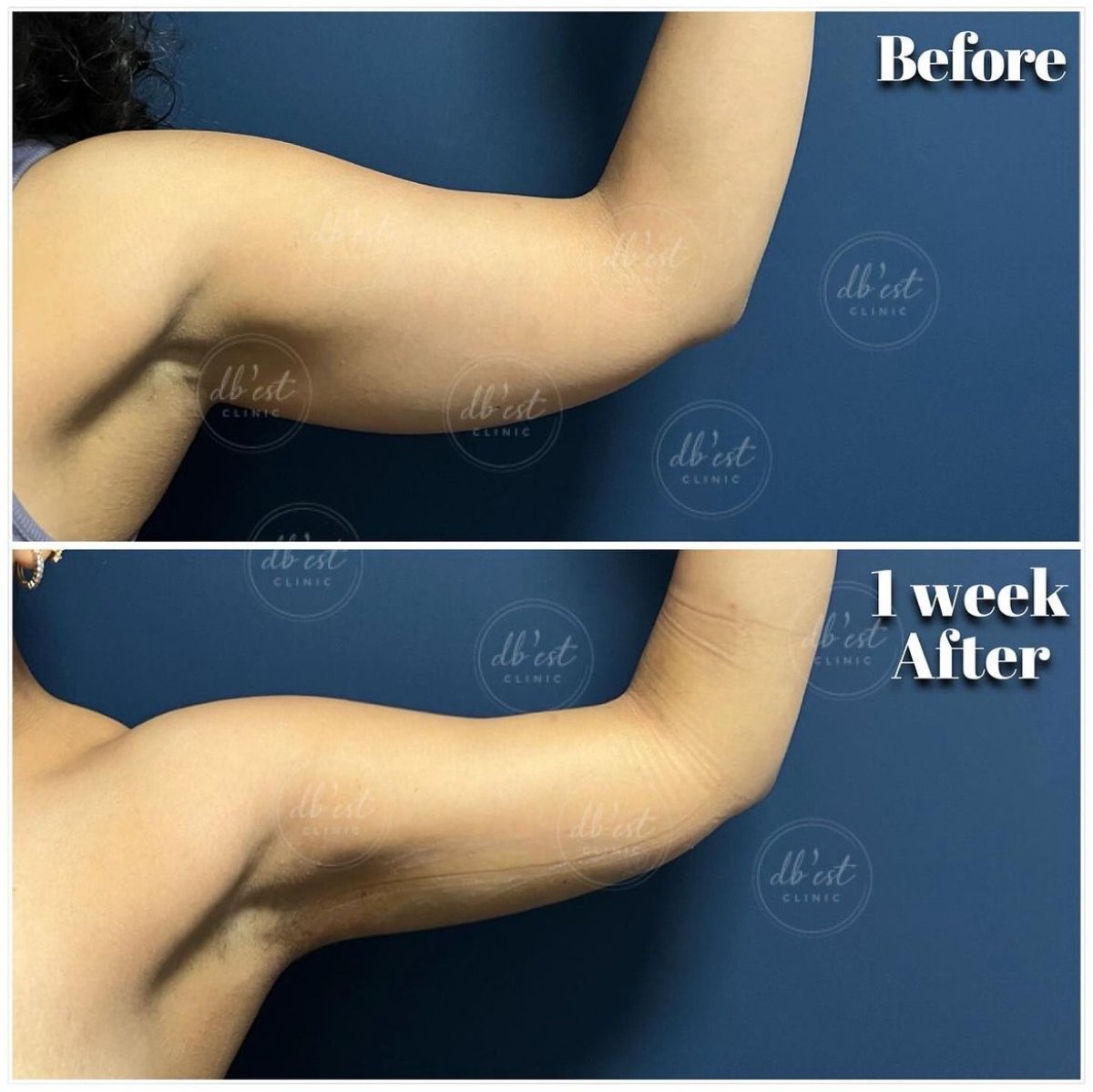 Resultados de lifting de brazos (braquioplastia) antes y después en Db'est Clinic, mejor contorno