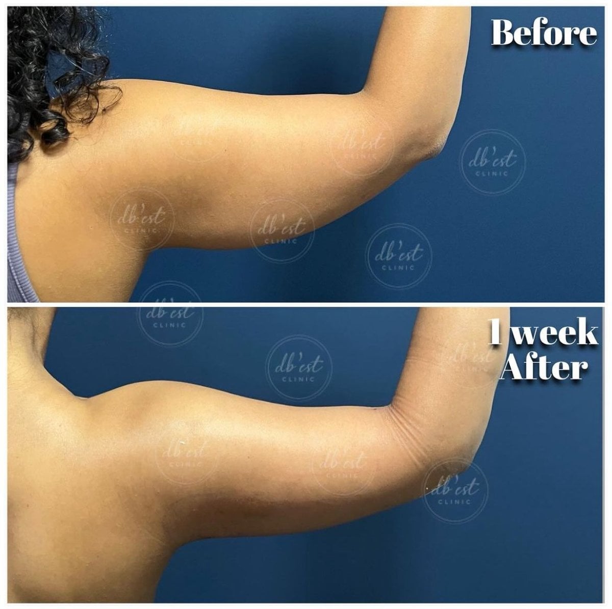 Resultados de lifting de brazos antes y después en Db'est Clinic, contorno mejorado