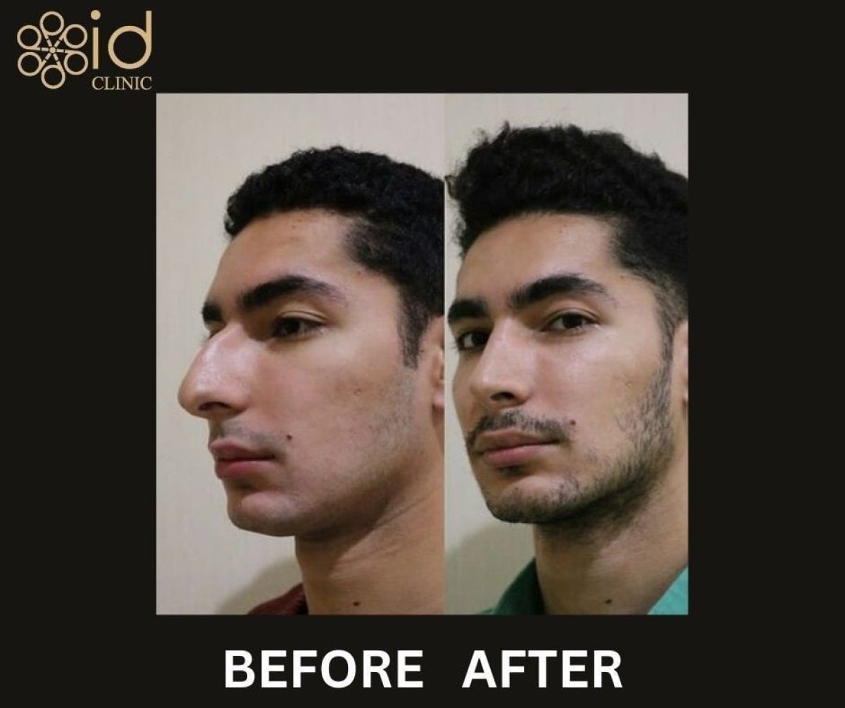 نتائج تجميل الأنف قبل وبعد في ID Clinic Bangkok، إعادة تشكيل الأنف لمظهر طبيعي